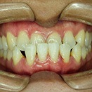 Gaps Between Teeth