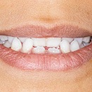 Lady smiles with gap in teeth