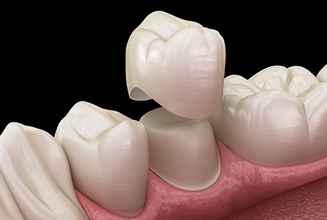 Rendering of dental crown over tooth in lower arch