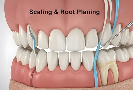 scaling and root planing is an effective way to combat gum disease